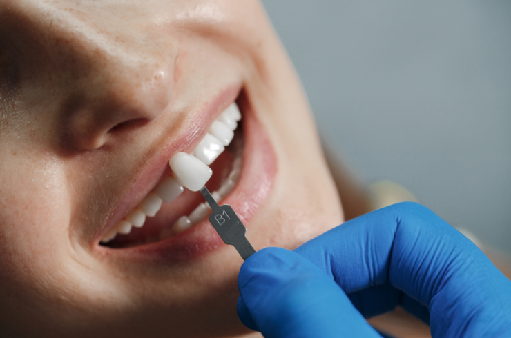 Dental Crowns and Bridges